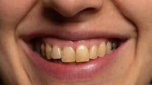 दांतों को सफेद करने के घरेलू उपाय
