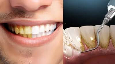 दांतों को सफेद करने के घरेलू उपाय